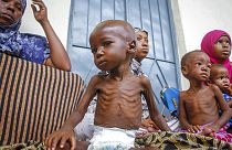 Niño afectado por la desnutrición aguda severa en Somalia