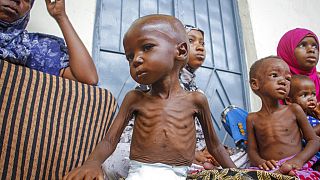 Niño afectado por la desnutrición aguda severa en Somalia