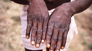 Ghana confirms five cases of Monkeypox