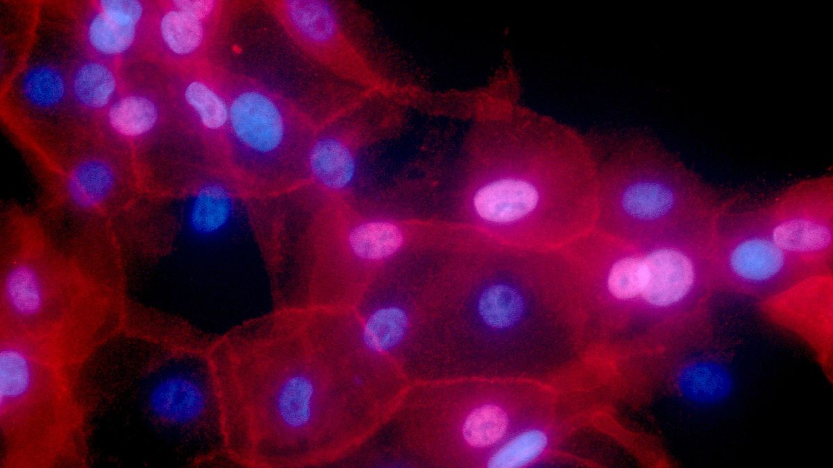 صورة مجهرية ملونة بالفلور لخلايا سرطانية بشرية للثدي. 