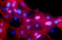 صورة مجهرية ملونة بالفلور لخلايا سرطانية بشرية للثدي.