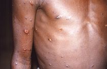 Lesões cutâneas provocadas pela varíola dos macacos