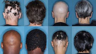 بخشی از افرادی که در تحقیقات شرکت کرده بودند پس از ۳۶ ماه مصرف دارو شاهد رشد موهای خود بودند