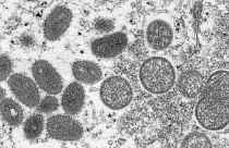 L'épidémie de variole du singe en Europe inquiète l'OMS