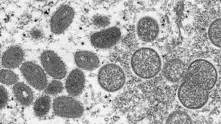 Grande parte dos casos de varíola dos macacos estão na Europa