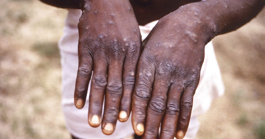 South Africa reports first case of monkeypox | Africanews