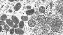 Вирус оспы обезьян под микроскопом