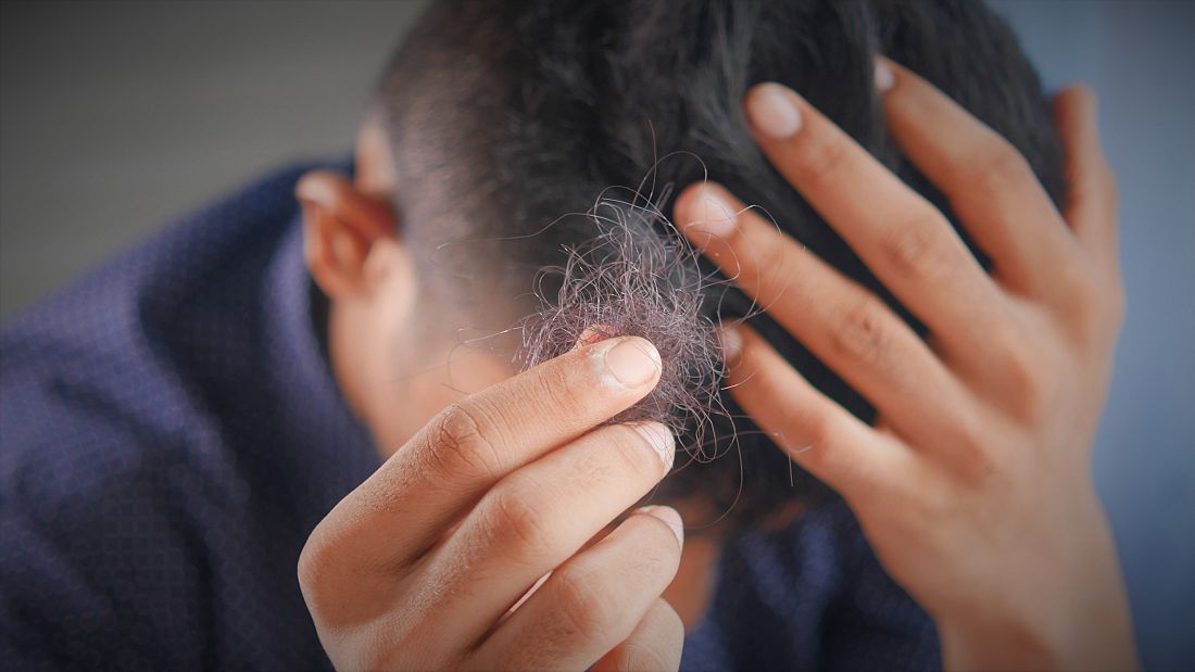 Long COVID New study reveals more symptoms including hair loss and
