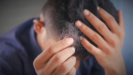 Hair loss and loss of libido have been linked to long COVID