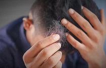 دراسة تربط تساقط الشعر والضعف الجنسي بالأعراض الطويلة لكوفيد 19