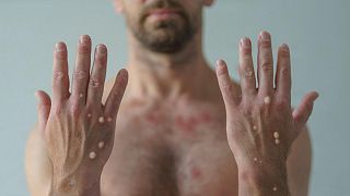 Over 1,000 cases of monkeypox have been recorded in New York, the epicentre of the United States' biggest outbreak of the virus.