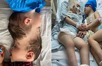 A pair of conjoined twins were successfully separated after nine complex surgeries in Brazil.