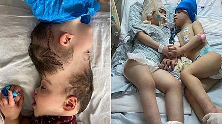 A pair of conjoined twins were successfully separated after nine complex surgeries in Brazil.