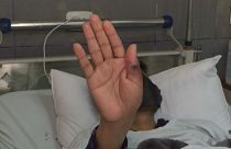Foto de uno de los pacientes ingresado en Perú debido a la viruela del mono