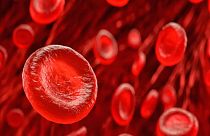 ¿Puede su grupo sanguíneo predecir el riesgo de sufrir un ictus?