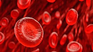 ¿Puede su grupo sanguíneo predecir el riesgo de sufrir un ictus?