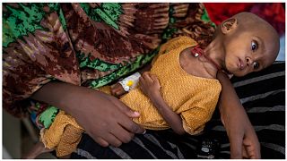 طفلة تعاني من سوء التغذية في مخيم للنازحين - الصومال - أرشيف