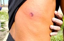 Un migrante venezolano muestra la herida que le produjo una bala de goma.