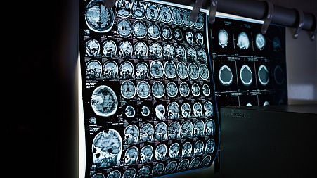 With NVision's Metabolic MRI, cellular changes can be seen within seven days.