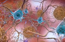 This illustration depicts cells in an Alzheimer’s affected brain, with abnormal levels of the beta-amyloid protein forming plaques, brown, that collect between neurons.