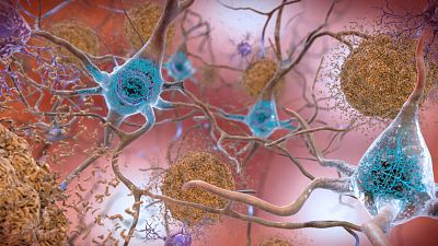 Esta ilustración facilitada por el Instituto Nacional sobre el Envejecimiento/Institutos Nacionales de Salud muestra células de un cerebro afectado por la enfermedad.