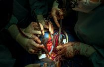 جراحون خلال عملية زراعة قلب في مستشفى جامعة بويرتا بالقرب من مدريد، إسبانيا.