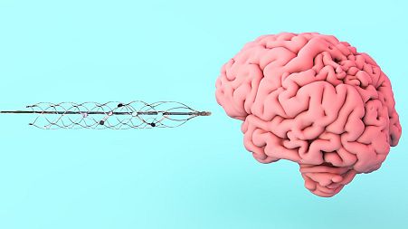Elon Musk’s Neuralink is betting on brain-computer interfaces, but this company is one step ahead