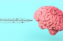Die Stentrode-Schnittstelle ist ein streichholzgroßes, netzartiges Gerät mit Elektroden, das in das Gehirn implantiert wird.