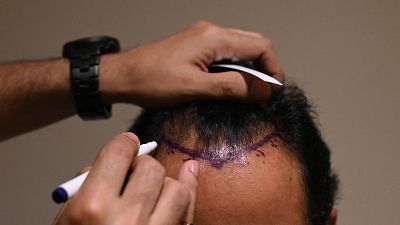 إجراء عملية زرع شعر بإحدى العيادات في الهند