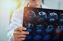 AI is improving outcomes for stroke patients in England