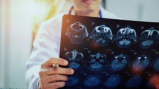 AI is improving outcomes for stroke patients in England