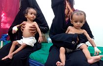 أطفال يعانون من سوء تغذية بسبب النزاع في اليمن