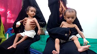 أطفال يعانون من سوء تغذية بسبب النزاع في اليمن