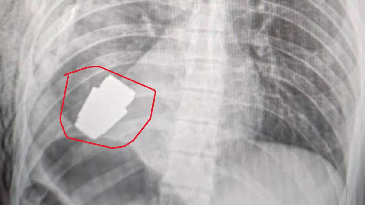 أشعة طبية تظهر قنبلة يدوية بداخل صدر جندي أوكراني.