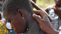 Côte d'Ivoire : la lèpre, une maladie encore négligée 