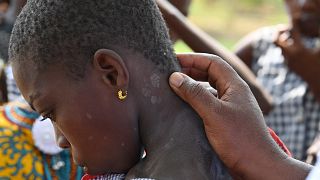 Côte d'Ivoire : la lèpre, une maladie encore négligée