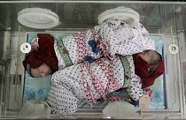 2011-ben, Afganisztánban született ikerpár képe