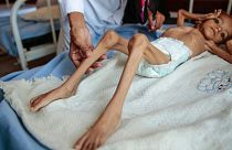 سوءتغذیه کودکان در جریان بحران انسانی یمن
