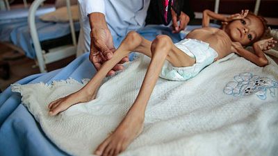 سوءتغذیه کودکان در جریان بحران انسانی یمن