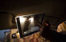 Radiografía de un paciente con tuberculosis