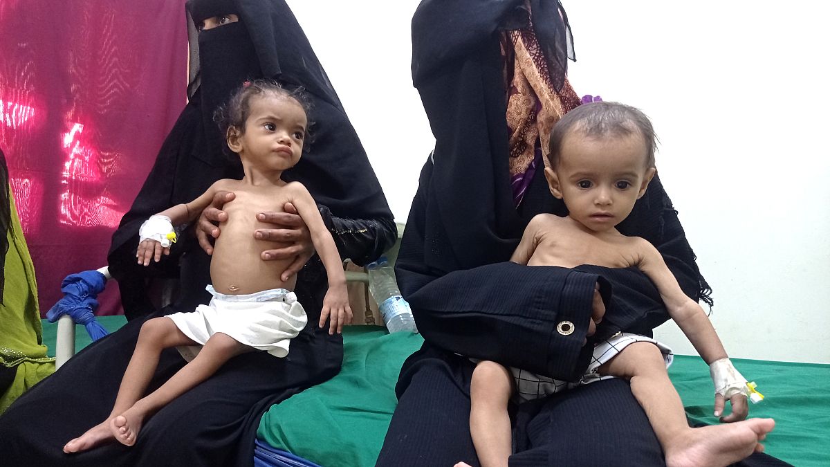 طفلاان يمنيان يعانيان من سوء التغذية في مستشفى بالحديدة