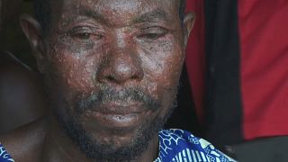 مرض جلدي غريب يصيب الصيادين في غينيا