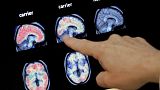 In this Aug. 14, 2018 file photo, a doctor looks at a PET brain scan at the Banner Alzheimers Institute in Phoenix