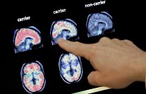 In this Aug. 14, 2018 file photo, a doctor looks at a PET brain scan at the Banner Alzheimers Institute in Phoenix