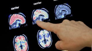 In this Aug. 14, 2018 file photo, a doctor looks at a PET brain scan at the Banner Alzheimers Institute in Phoenix