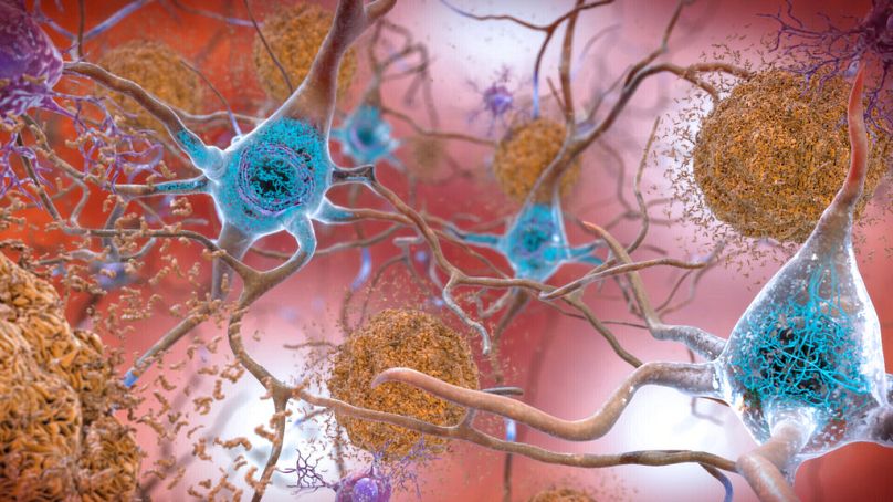 Alzheimer'dan etkilenen bir beyindeki hücreler.