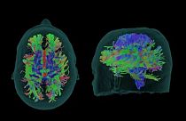 Yeni Alzheimer ilacı 'donameab' hastalığın ilerlemesini üçte bir yavaşlatıyor