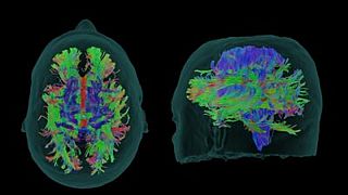 Yeni Alzheimer ilacı 'donameab' hastalığın ilerlemesini üçte bir yavaşlatıyor