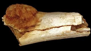 اولین مورد سرطان ثبت شده ۱.۷ میلیون سال پیش رخ داد. این سرطان در استخوان انگشت پای یکی از بستگان اولیه انسان پیدا شده است.