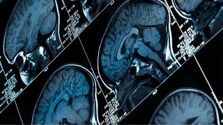 Forscher haben zum ersten Mal Gehirnsignale für Schmerzen entschlüsselt